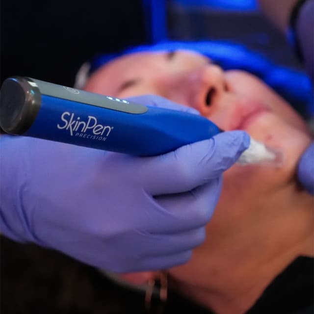 SkinPen VAMP Face + Neck at Beauty by Nurse C in Pembroke Pines, FL